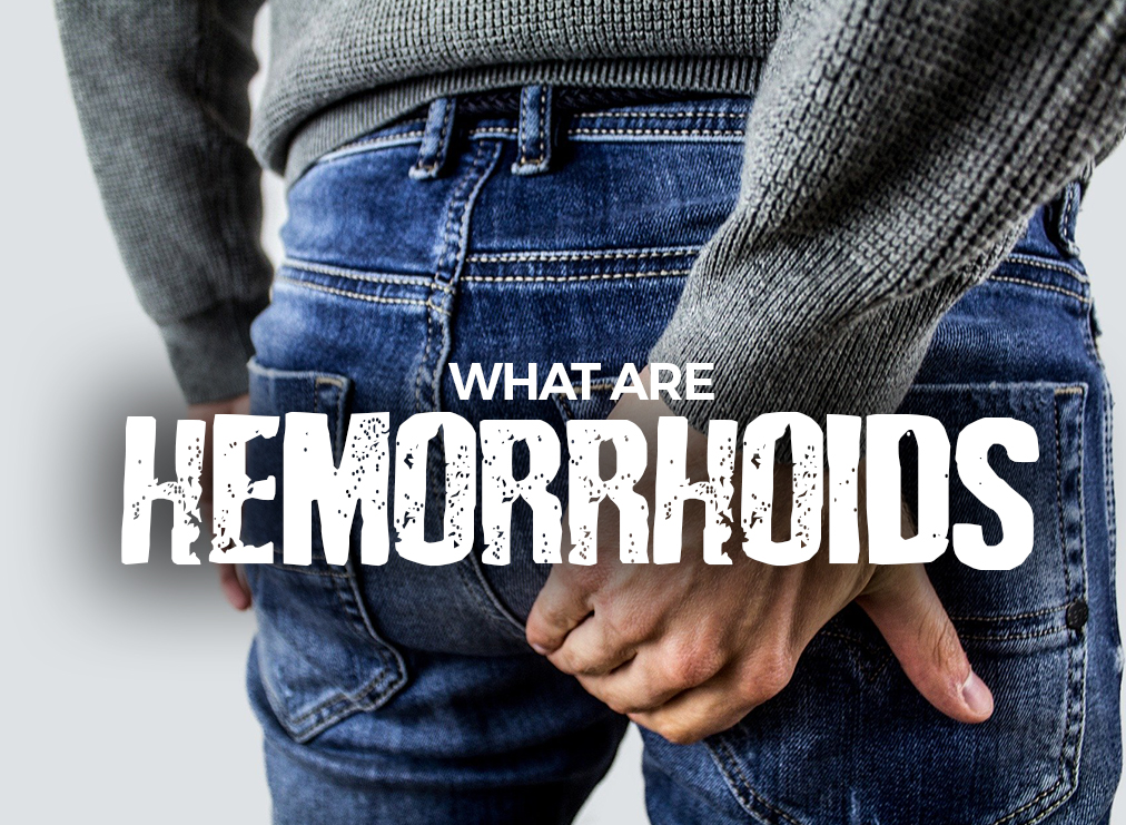 Hemorrhoids: What They Are, How They Arise, and What Treatments Exist