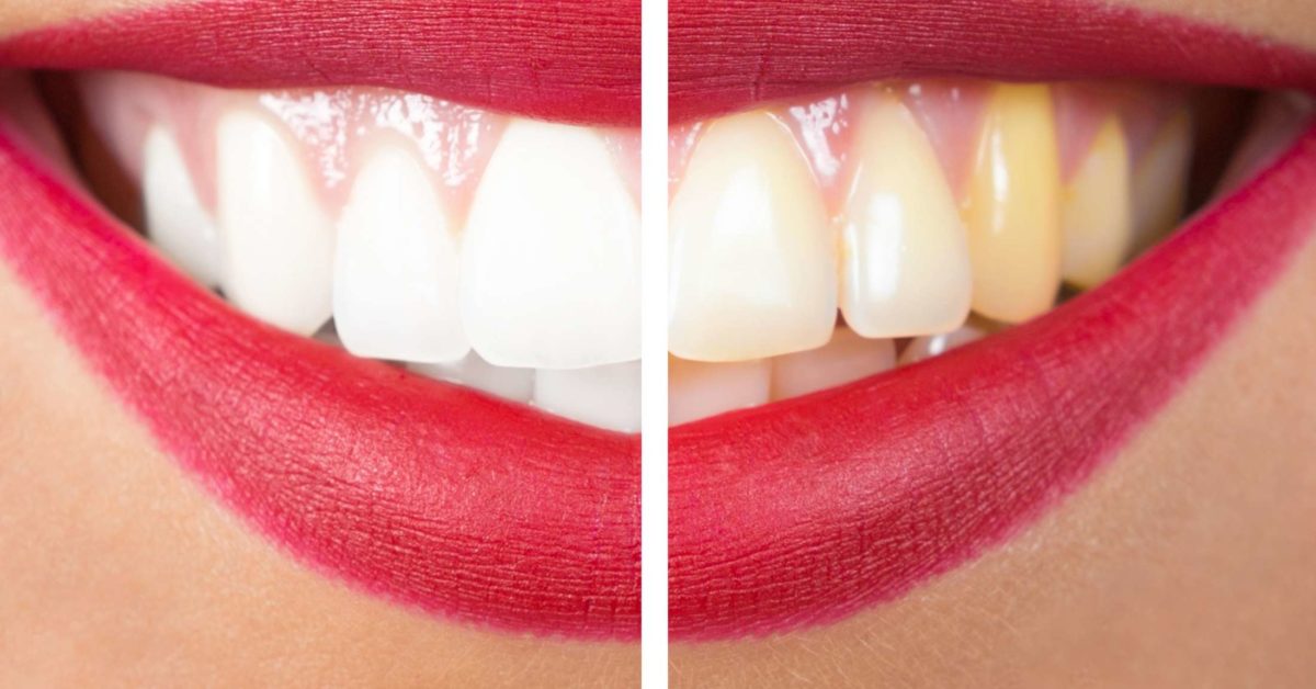 These Foods Can Make Teeth More Yellow - See What They Are